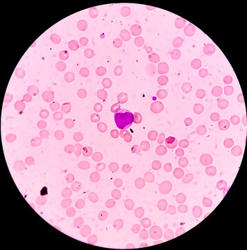 Microscopic view of Acute myeloid leukemia (AML), myeloblastic Leukemia, a cancer of white blood cells, RBC. WBC. closeup. Stained slide. Smear. Platelet