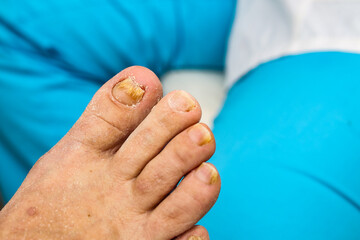 Onychomycosis, a nail disease caused by pathogenic fungi.