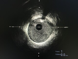 Intravascular ultrasound imaging (IVUS) at cardiac catheterization laboratory room.