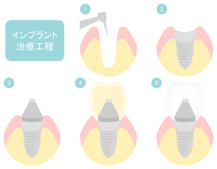 歯のインプラントの治療工程イラスト