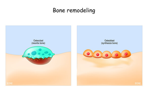 Bone remodeling