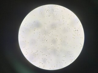 Moderate white blood cell and bacteria cell in urine.