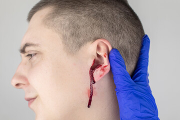 A man whose ear is bleeding. Vascular rupture, damage to the tympanic membrane, ear diseases,...
