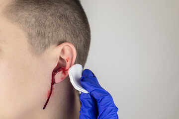 A man whose ear is bleeding. Vascular rupture, damage to the tympanic membrane, ear diseases, oncology, otitis media, myringitis