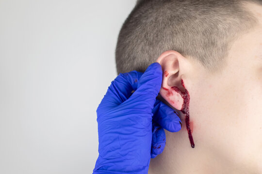A man whose ear is bleeding. Vascular rupture, damage to the tympanic membrane, ear diseases, oncology, otitis media, myringitis
