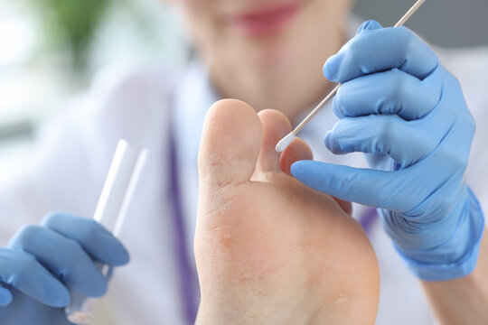 Doctor treating patients toes in clinic closeup