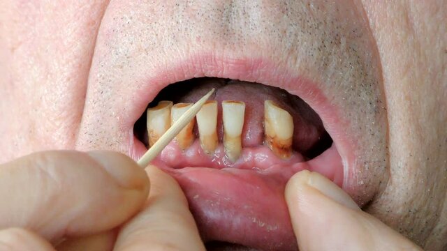 An old retiree checks his broken teeth with a forefinger