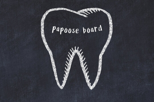 Chalk Drawing Of A Tooth With Medical Term Papoose Board. Concept Of Learning Stomatology