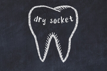 Chalk drawing of a tooth with medical term dry socket. Concept of learning stomatology