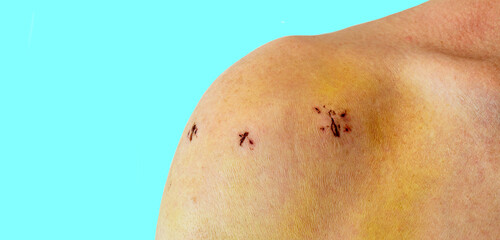 Male shoulder with scars after shoulder Arthroscope surgery. Chronic dislocation of the long biceps...