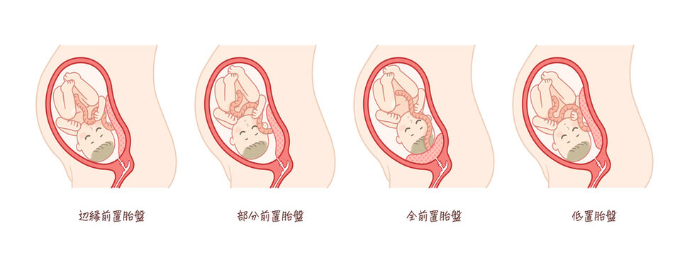 2 Best Marginal Placenta Previa Images Stock Photos Vectors Adobe Stock 2 Best Marginal Placenta Previa Images Stock Photos Vectors Adobe Stock