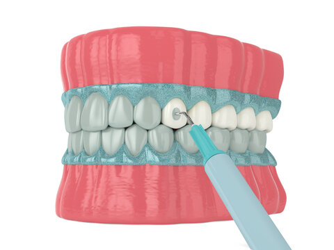 3d render of jaw with applying activating gel for teeth bleaching.