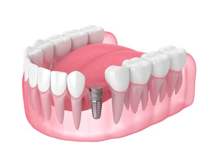 Obraz premium 3d render of jaw with implant screw and buried healing cap under gums