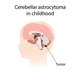 Cerebellar astrocytoma in childhood. Brain cancer, tumor with explanations.
