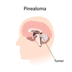 Pinealoma. Brain cancer, tumor with explanations. Inner view.