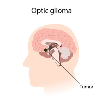 Optic Glioma. Brain Cancer, Tumor With Explanations.