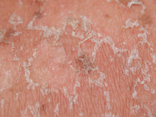 problematic human skin close up with pigmentation and redness peels off after sunburn
