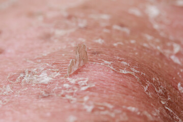 texture of problematic human skin close up with pigmentation and redness peels off after sunburn