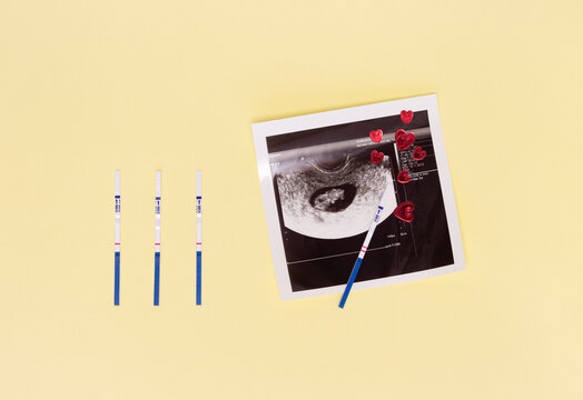 Negative and positive pregnancy test strips, ultrasound picture of the fetus, red hearts. The concept of conception, waiting for the birth of a child, a family.