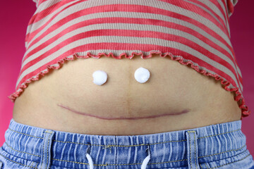Smile from the cream on the stomach with a caesarean section. The concept of postpartum recovery