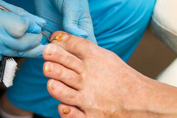 Doctor treats an ingrown toenail with a medical instrument, removal and disinfection