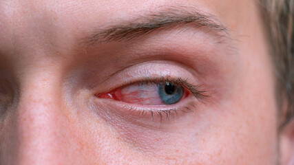 Close up irritated infected red bloodshot eyes. Conjunctivitis. Inflammation of the eyes. Mens red eye close-up, fatigue, problems with blood vessels. Red eye for irritation of the sclera