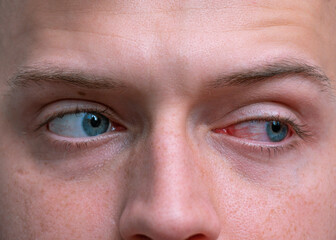 Close up irritated infected red bloodshot eyes. Conjunctivitis. Inflammation of the eyes. Mens red...