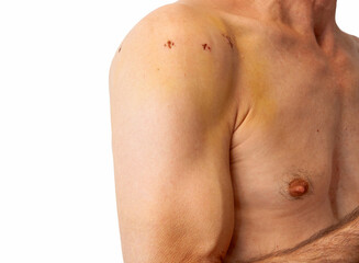 Male shoulder with scars after shoulder Arthroscope surgery. Chronic dislocation of the long biceps...