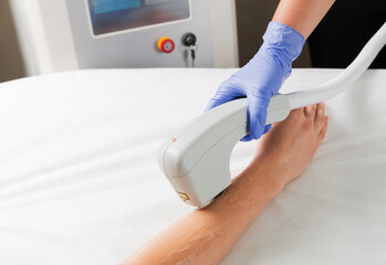 Hand hair removal procedure using laser hair removal technology.