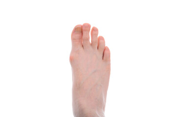 Obraz premium The onset of degenerative disease on the leg due to poor footwear in a man 