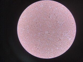 Moderate Fresh red blood cells and white blood cells in urine.