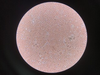 Moderate Fresh red blood cells and white blood cells in urine.