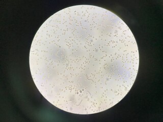 Moderate Fresh red blood cells and white blood cells in urine.