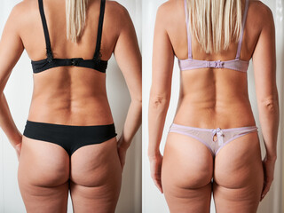 Back view of woman's body before and after weight loss, plastic surgery concept