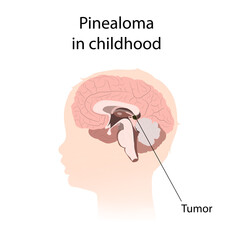 Pinealoma in childhood. Brain cancer, tumor with explanations.