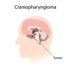 Craniopharyngioma. Brain cancer, tumor with explanations. Inner view.