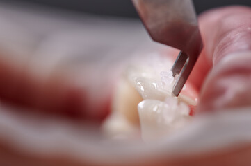 Close up of orthodontist installing orthodontic brackets on patient teeth. Person with braces on...