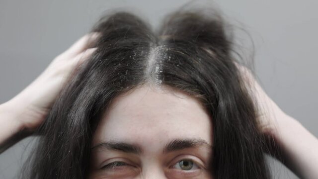 A woman strongly scratches her head with her hands. Dark hair with dandruff. Close-up. The concept of hair problems