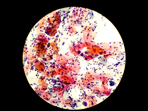 Normal endocervical cells and squamous epithelial cells of cervical human view in microscopy.Cytology criteria from pap smear.Medical background concept.