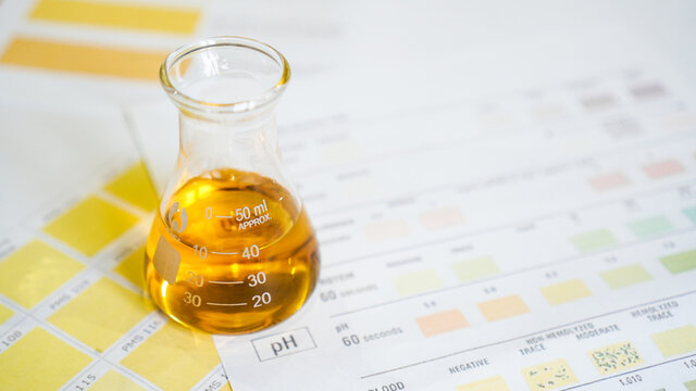 A flask with urine. Medical analyzes concept. Determination of the diagnosis by the color of urine. Chart with colors.