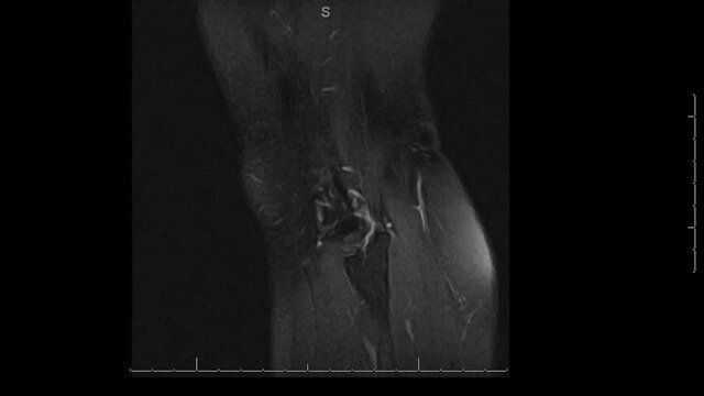 MRI without contrast of knee cap in looping scan.

