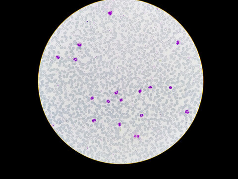 Human peripheral blood smear under 40x light microscope present increase white blood cells, eosinophil, neutrophil called neutrophilic leucocytosis.