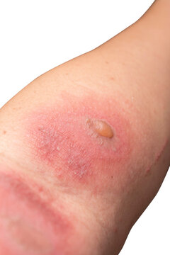 Blister from Rove beetles ,Paederus dermatitis at arm