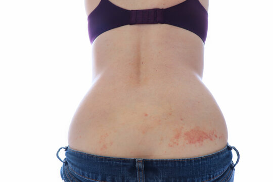 Woman with scabies on her back caused from mites burrowing in the skin.