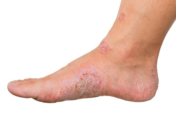 Wounds and dry skin on human foot. Ulcers and infection of medical concepts.