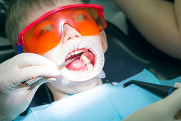 Kids dentistry. Children's dentist examination baby teeth. Emotions of a child in a dental chair. Little boy in protective orange glasses and cofferdam. Process treatment caries. 
