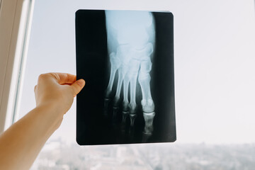 Hand holding an x-ray roentgen with a broken male foot.
