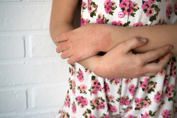 Hands of a little girl with contact dermatitis, Concept with Healthcare And Medicine. Contact...