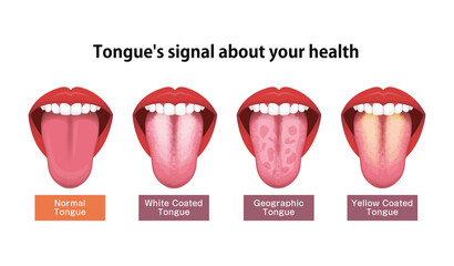 Tongue’s health sign vector illustration ( White coated tongue ) © barks