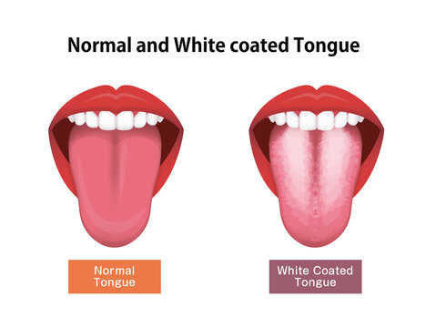 Tongue’s health sign vector illustration ( White coated tongue )
